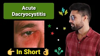 Acute Dacryocystitis Lecture opthalmology