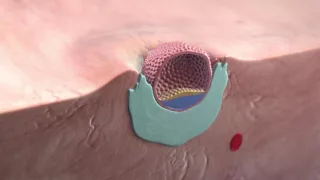 Implantation of the blastocyst