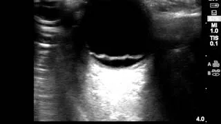 Ocular Ultrasound: Retinal Detachment