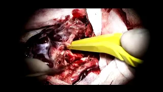 Удаление АВМ (артерио-венозной мальформации) головного мозга и клипирование аневризм