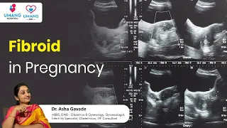 Fibroid in  Pregnancy | Dr. Asha  Gavade | Umang Hospital