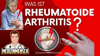 Rheumatoide Arthritis (deutsch) — Rheumatologe erklärt RHEUMA