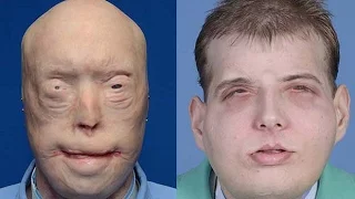 'Most extensive' face transplant completed