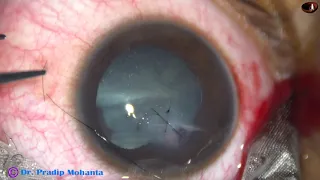 Repair of Corneal wound : Pradip Mohanta, 14th May, 2020