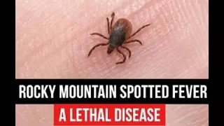 Rocky Mountain Spotted Fever update
