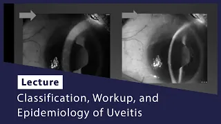 Classification, Workup, and Epidemiology of Uveitis