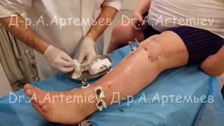 Снятие аппарата Илизарова после коррекции голени