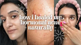 How I naturally balanced my hormones and cured my acne (no accutane or birth control)