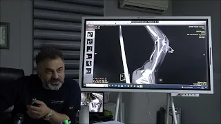 Kol veya bacakta damar yumağı - Prof. Dr. Ahmet AKGÜL