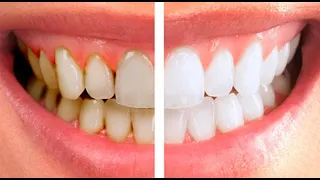 Профессиональная чистка зубов Air Flow в стоматологии Диалог