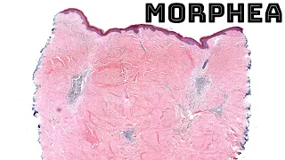 Morphea skin disease (localized scleroderma) histology pathology dermatology dermpath