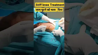 Stiff Knee जाम घुटने का Full मूवमेंट करा दिया surgery से | #kneesurgeryrecovery #kneesurgey#kneepain