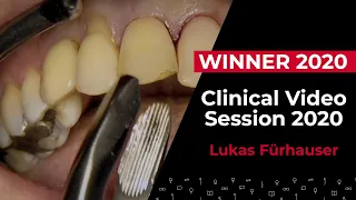 Adjacent immediate implants in the esthetic area w/ Lukas Fürhauser (Winner)