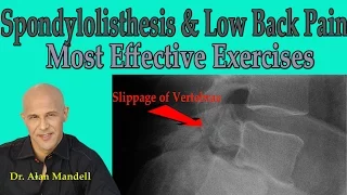 Spondylolisthesis and Low Back Pain (Most Effective Exercises) - Dr Mandell