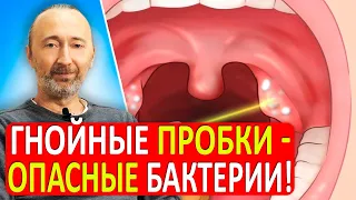 Гнойные пробки в миндалинах: причины и надёжное лечение! Как устранить ЭТИ бактерии раз и навсегда?