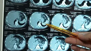 how to read CT scan chest abdomen and pelvis and pick up the findings of acute pancreatitis