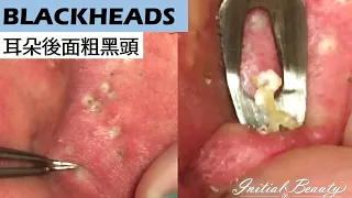 耳朵後面粗黑頭(blackheads behind the ear) - Taiwan Tainan台南清粉刺最乾淨