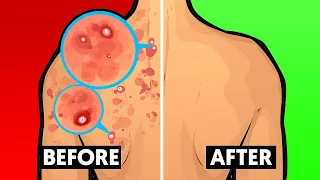 How To Get Rid of Back Acne Fast