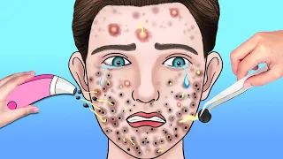 ASMR Giant Acne & Black Head Pimple Removal - Acne Deep Cleaning Animation | ASMR Animation