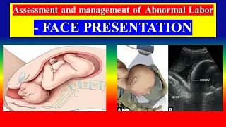 Assessment and management of  Abnormal Labor - FACE PRESENTATION - OBG