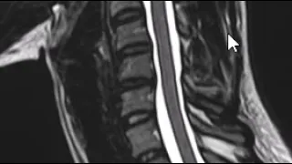 How to read and MRI of the cervical spine | First Look MRI