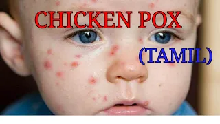 Chicken pox in tamil |class medics|.