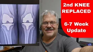 Second Knee Replaced, 6 to 7 weeks after surgery.  Total Knee Replacement