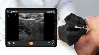 Ultrasound of the Submandibular Gland