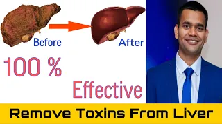 Liver Detox | Remove Toxins From your Liver | Dr. Vivek Joshi