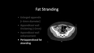 Abdominal CT Scan interpretation for Acute Appendicitis