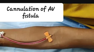 First time AV fistula (AVF) Cannulation step by step guide Assessment of AV fistula