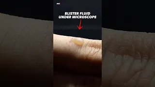 Blister Fluid Under Microscope (White Blood Cells)