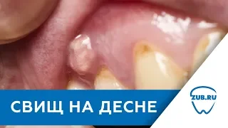 Свищ на десне