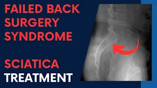 FAILED Back Surgery Syndrome, STILL have SCIATICA, HELPED by Dr Suh