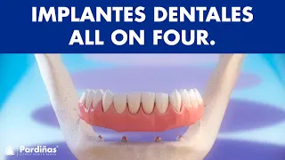 Implantes dentales - Tratamiento All on Four ©