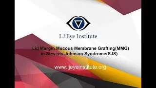 Lid margin mucous membrane grafting(MMG) in Stevens - Johnson Syndrome(SJS)