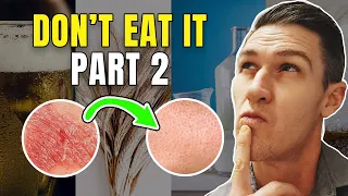 5 Foods to Remove if you Have Psoriasis - Part 2 | How to Treat Psoriasis