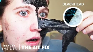 Charcoal Peel-Off Mask Claims To Unclog Pores | The Zit Fix