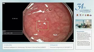 Artificial intelligence in colonoscopy: The future is here by David HEWETT