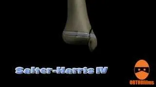 Salter-Harris Fractures