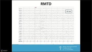Троицкий А.А. Физиологические паттерны на Видео ЭЭГ
