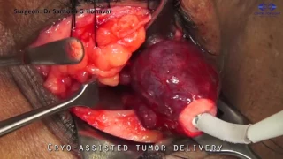 Orbitotomy Simplified - Transconjunctival Approach