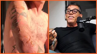 Steve-O on his MOST Painful Injury