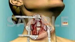 Anterior Cervical Fusion: 3D Medical Animation