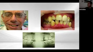 The Magical Powers of Implant Overdentures