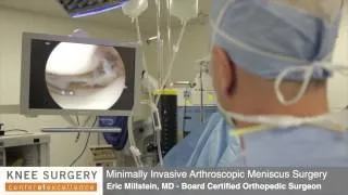 Arthroscopic Knee Surgery | Meniscus Surgery Performed by Dr. Millstein