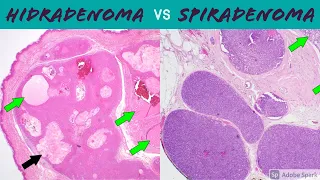 Hidradenoma (Acrospiroma) vs Spiradenoma/Cylindroma: 5-Minute Pathology Pearls