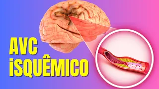 ACIDENTE VASCULAR CEREBRAL ISQUÊMICO (AVCI) - CAUSAS, SINTOMAS E TRATAMENTOS