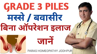 ग्रेड 3 पाइल्स कैसे ठीक होंगे | Grade 3 Hemorrhoids Treatment | Third grade piles Treatment | मस्से