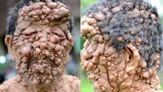 Man Has Hundred Of Tumours Growing On His Face & Head